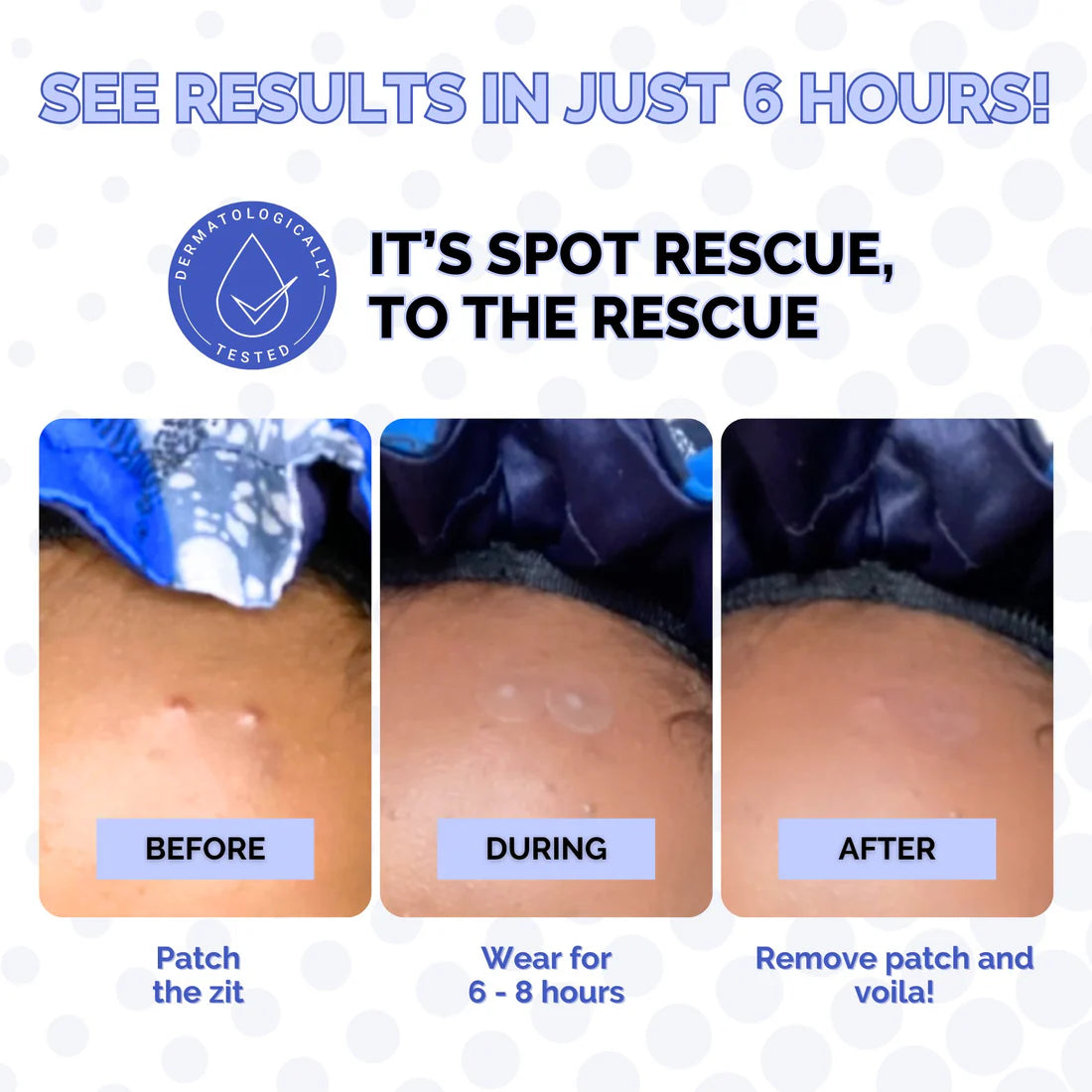 Spot Rescue Blemish Patches by Elizabeth Mott - 36 Patches