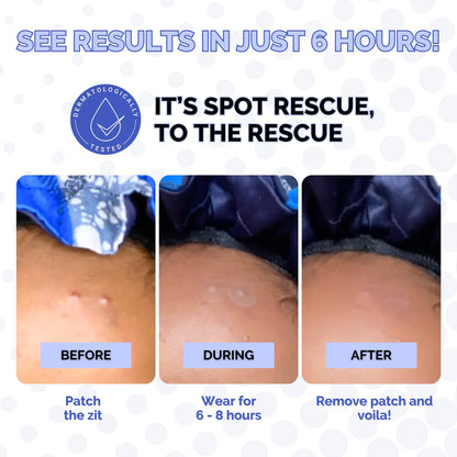 Spot Rescue Blemish Patches by Elizabeth Mott - 36 Patches